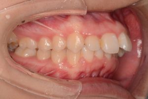 悪いかみ合わせを構成する歯並びは3種類