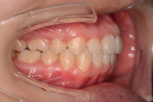 奇麗な歯並びは口腔・全身・精神にメリットがある