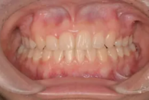 抜歯の判定には石膏模型やレントゲン写真が用いられる