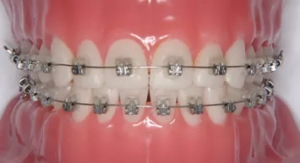 表側矯正はいろいろな歯並びに適応できる