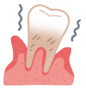 歯並びの悪さは歯磨きの精度を落とし・噛み合わせを悪くする
