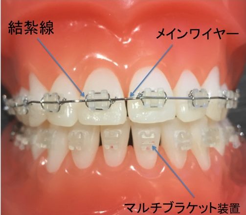 結紮線は歯列矯正治療で使用する装置のひとつ。種類 どのような効果か解説