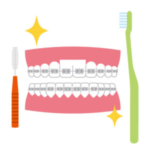それぞれの矯正装置の特徴を理解して歯磨きする