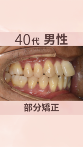 前歯　出っ歯　部分　治療前