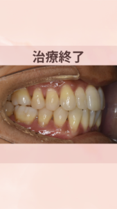 前歯　出っ歯　部分　治療後
