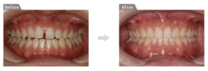 軽度の出っ歯・すきっ歯を改善できる