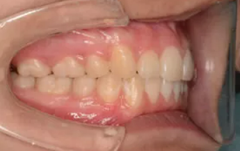 日々の歯磨きと定期的な通院で腫れを予防