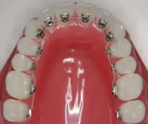 裏側矯正は歯の裏側に装置を取り付ける