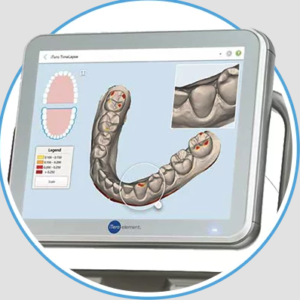 iTeroは口腔内全体をスキャニングできる装置