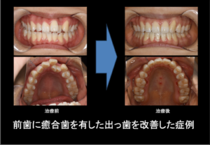 前歯に癒合歯を有した出っ歯を抜歯を伴うハーフリンガル （上顎:表側 下顎:裏側 のワイヤー矯正）で改善した症例