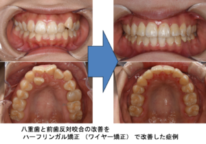 八重歯と前歯反対咬合の改善を ハーフリンガル矯正（ワイヤー矯正）で改善した症例