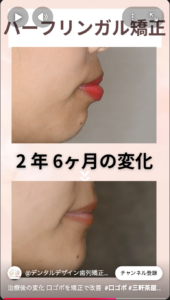 口ゴボ(上下顎前突)を裏側矯正で改善 ビフォーアフター 口唇