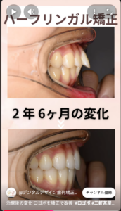 口ゴボ(上下顎前突)を裏側矯正で改善 ビフォーアフター 口腔内