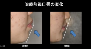横顔 　矯正治療後の　ビフォーアフター