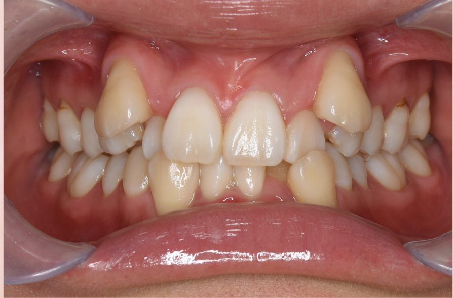 抜く？抜歯？八重歯への矯正歯科治療方法では最新ではどう改善するのか