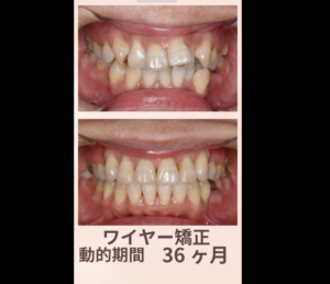 ハーフリンガル　矯正治療のビフォーアフター