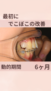 20代　女性　ハーフリンガル 