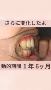 20代　女性　ハーフリンガル