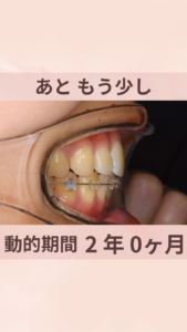 20代　女性　ハーフリンガル