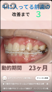 ハーフリンガル矯正での治療　治療中