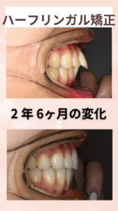 矯正治療前後の歯並びの変化