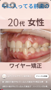 ハーフリンガル矯正での治療　治療前