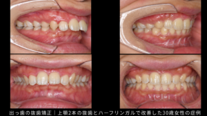 出っ歯の抜歯矯正|上顎2本の抜歯とハーフリンガルで改善した30歳女性の症例