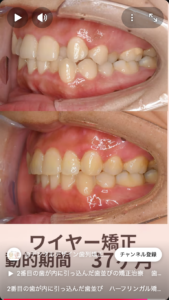 ハーフリンガル矯正での治療　治療前後