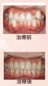 スリー　インサイザー　前歯一本抜歯
