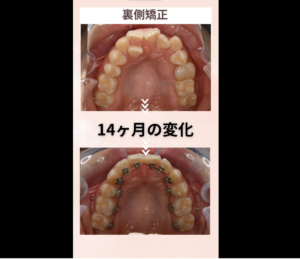 内に入った歯並びの改善 裏側矯正