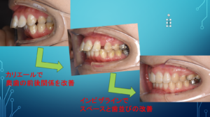 カリエールの効果