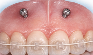 前歯圧下用アンカースクリュー