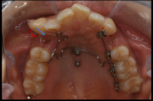 アンカースクリューと裏側矯正