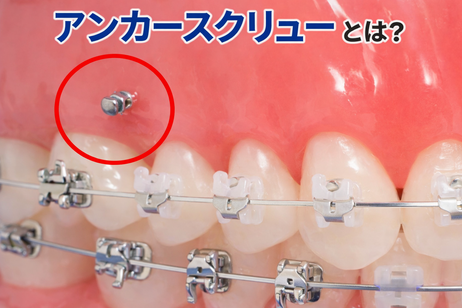 【裁断済】アンカースクリューを用いた新しいMTM矯正 歯科矯正用アンカースクリューを用いた矯正 - 仙台キュア矯正歯科