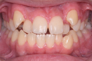 八重歯　イメージ