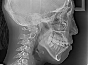 セファログラム(cephalogram 頭部X線規格写真)