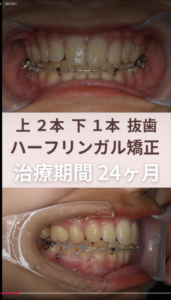 出っ歯とすきっ歯と裏側矯正治療 治療途中