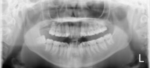 初診時のパノラマX線写真