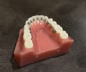 裏側矯正
