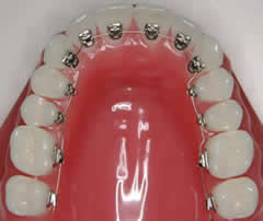 歯の裏側の矯正装置