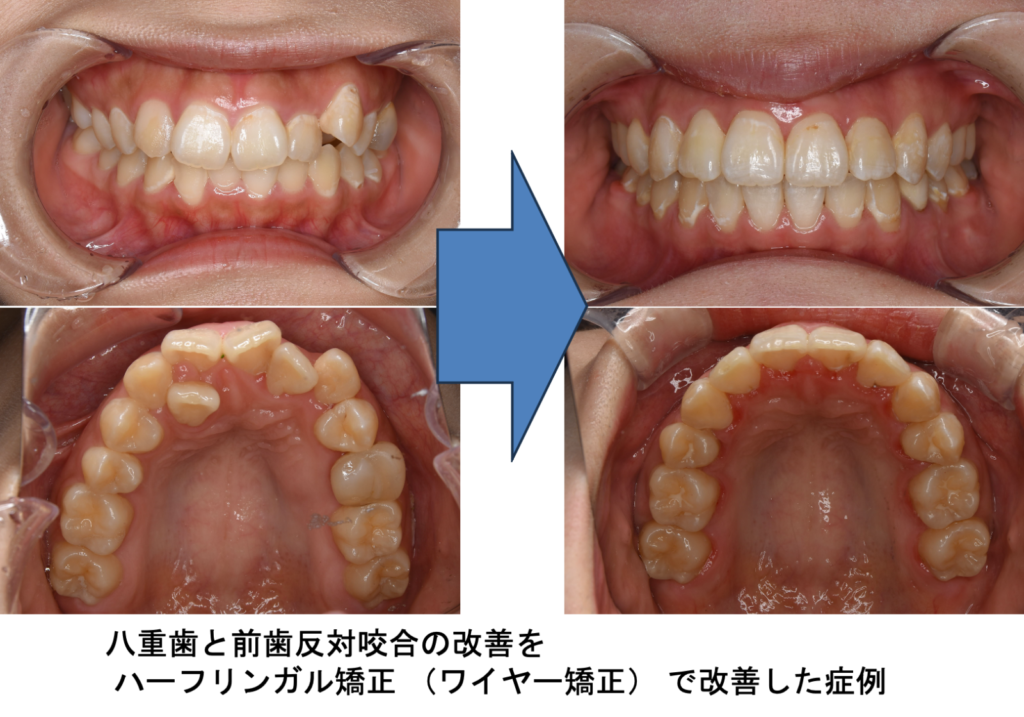 八重歯と前歯反対咬合の改善を ハーフリンガル矯正（ワイヤー矯正）で改善した症例